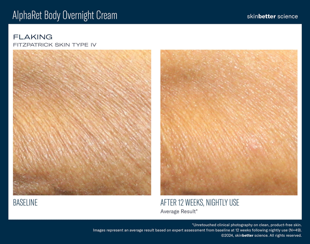 AlphaRet Body Overnight Cream