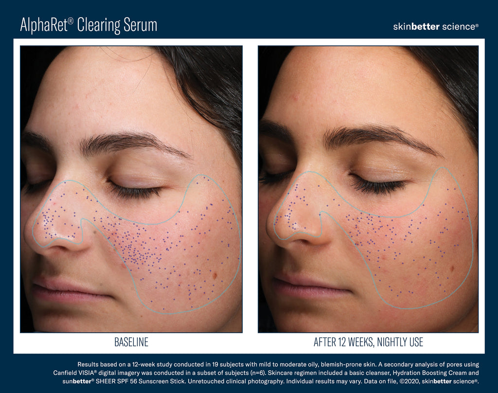 AlphaRet Clearing Serum 50 ml