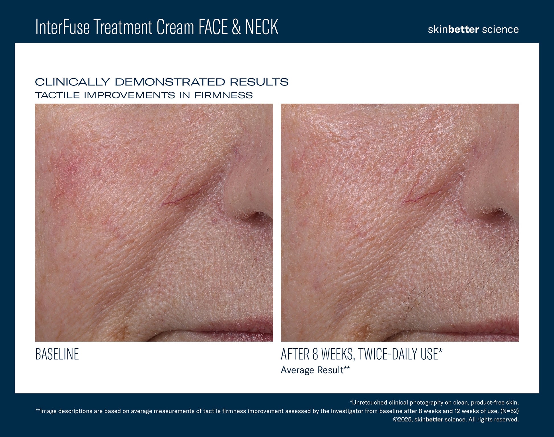 InterFuse Treatment Cream FACE & NECK 50 ml